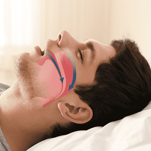 Oral Appliance Therapy