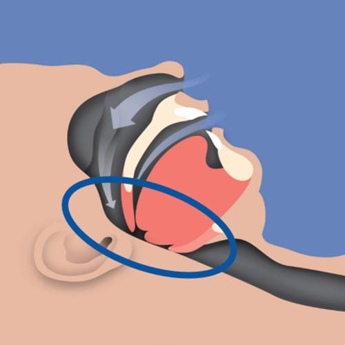 Sleep Apnea