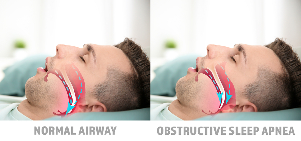 Illustrations showing difference between normal breathing and obstructive sleep apnea