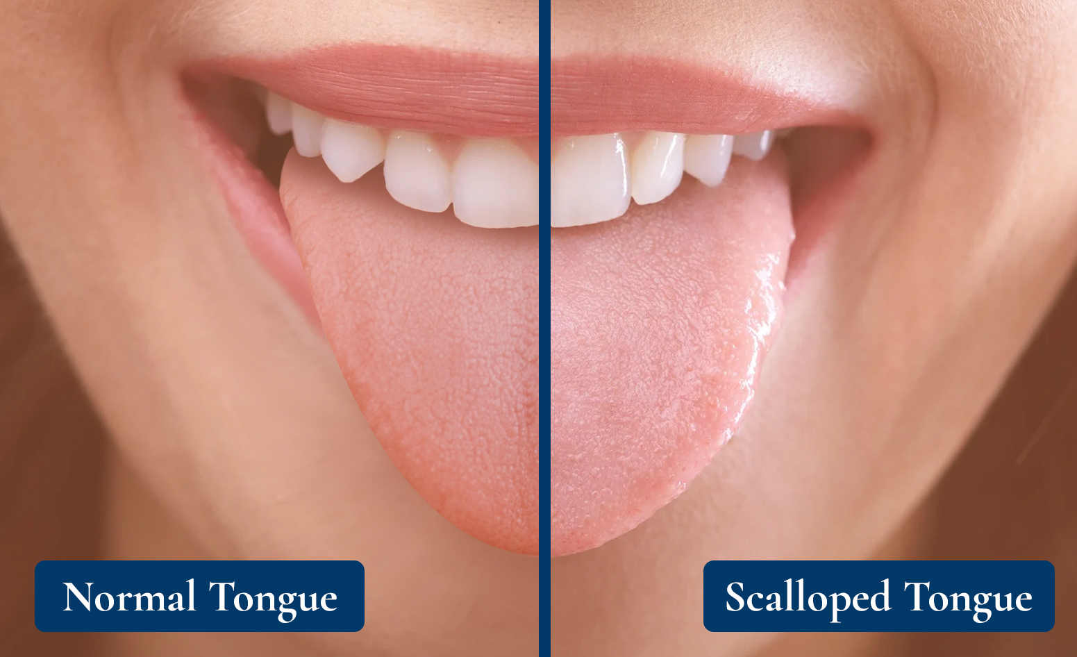 Scalloped Tongue