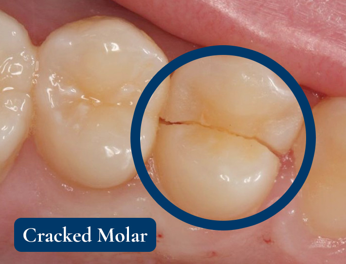 Cracked Molar