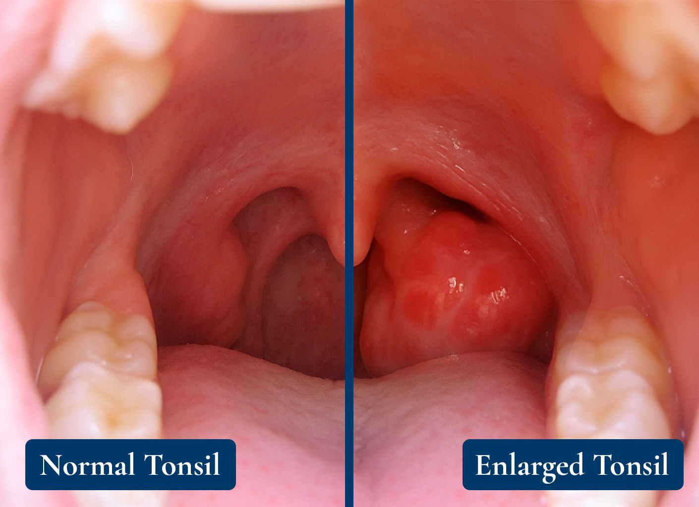 Enlarged Tonsils
