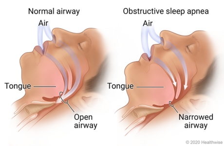 Comparison of a narrowed airway versus an expanded airway