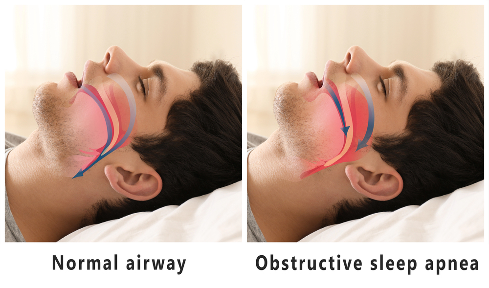 Airway Expansion Diagram
